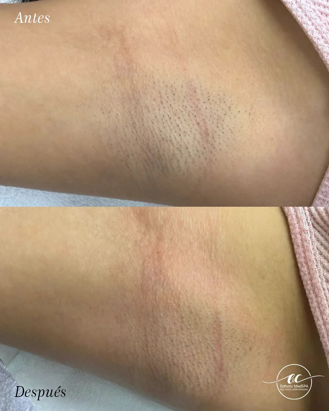 Diode laser hair removal before and after