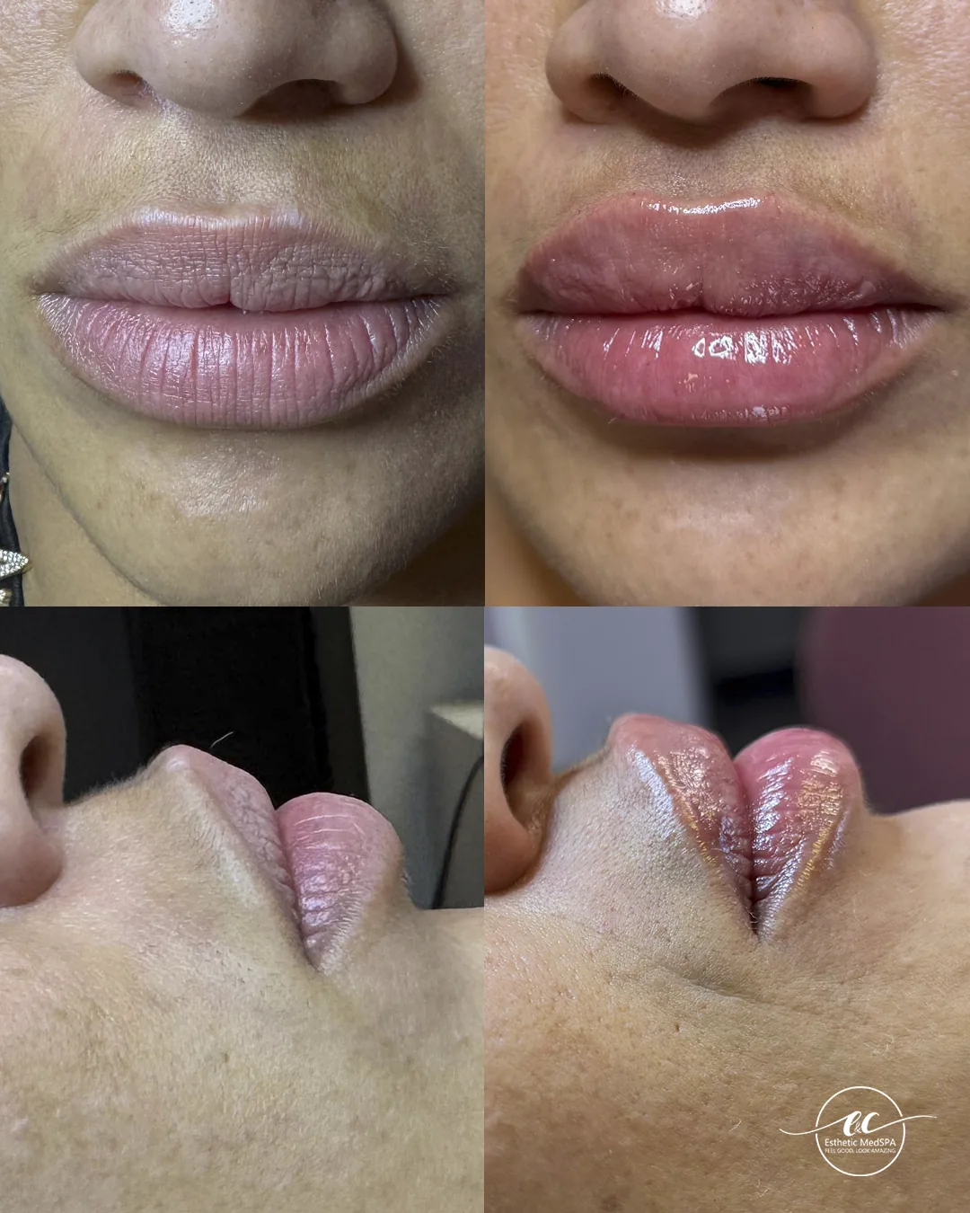 Lip enhancement before and after result