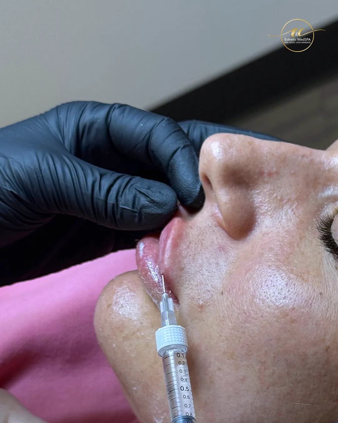 Lip enhancement facial treatment